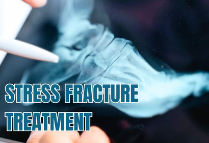 Stress Fracture treatment by Dr Karthik Gudaru